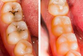 dentalfillings