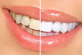 teethwhitening